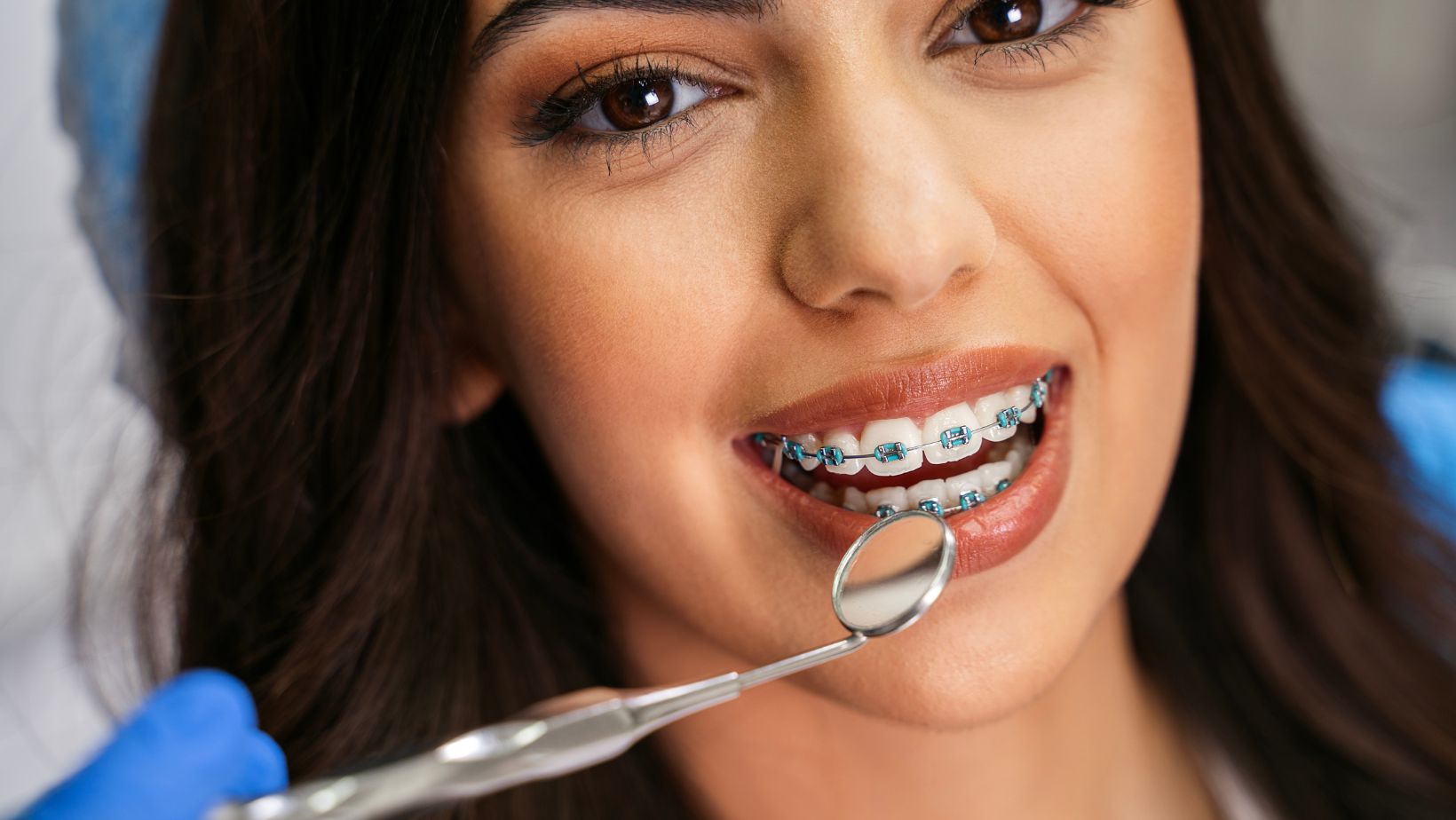 Dental Braces